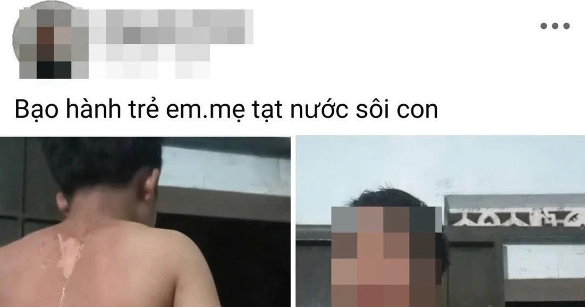 Công an vào cuộc vụ bé trai ở Đắk Lắk nghi bị mẹ tạt nước sôi