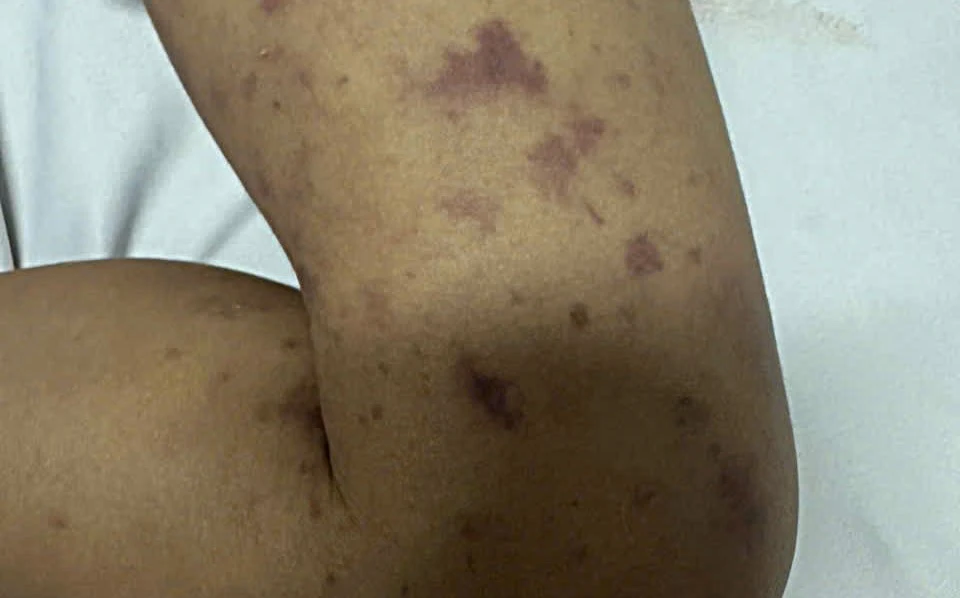 Cháu tử vong do não mô cầu, chú ruột 40 tuổi cũng nhiễm bệnh