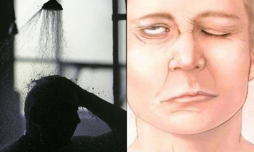 Nam thanh niên 23 tuổi bị liệt dây thần kinh số 7 vì một thói quen khó sửa