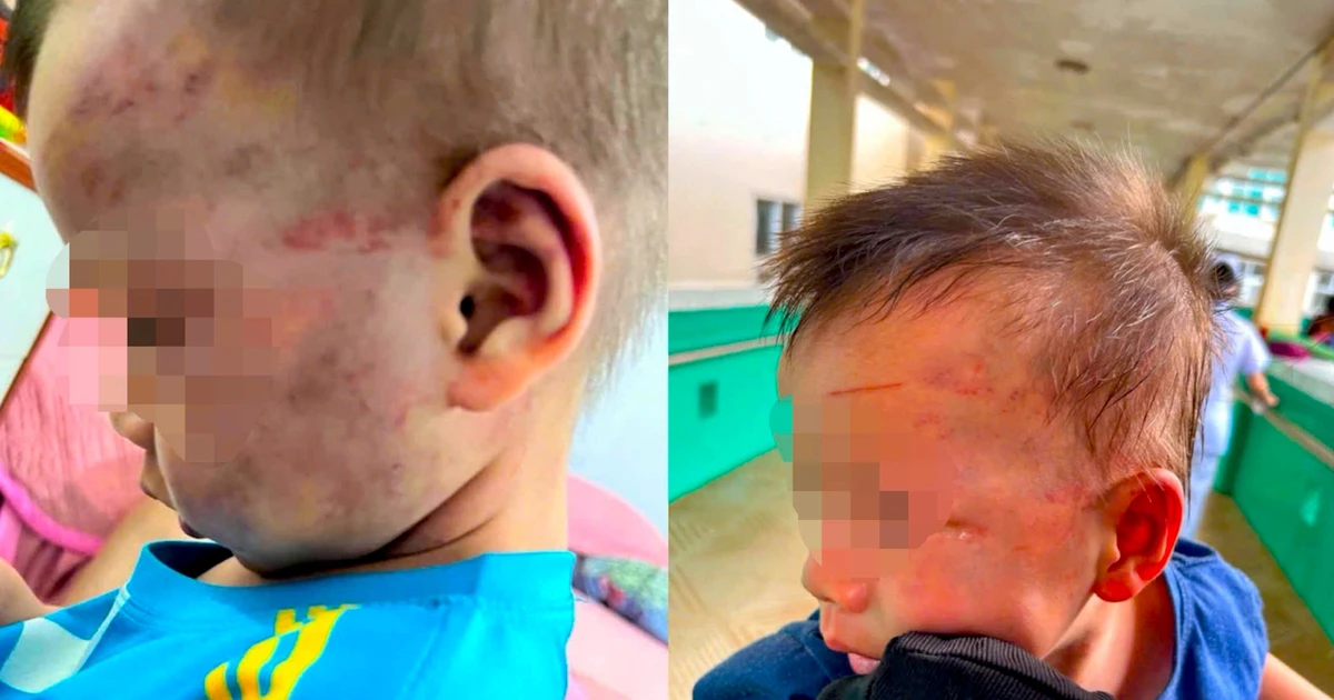 Tạm giữ cha dượng đánh bé 3 tuổi bầm tím mặt mũi