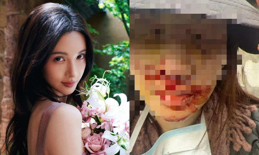 Kim Thần công bố ảnh bị thương nặng ở mặt, cảnh sát làm rõ vụ gây tai nạn bỏ trốn