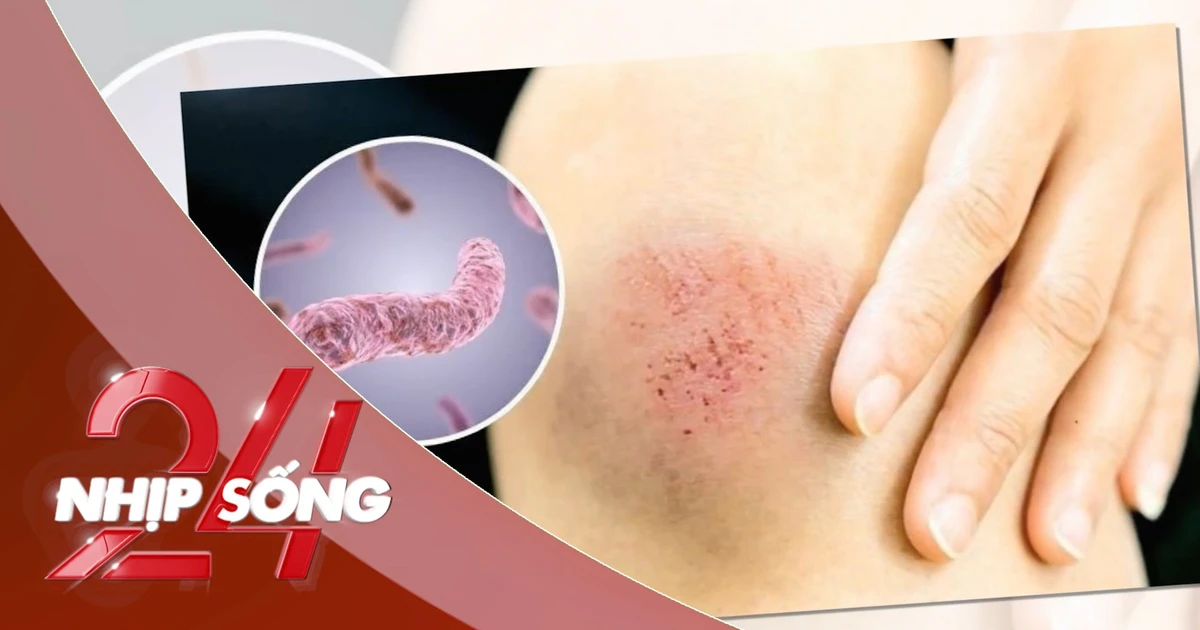 NHỊP SỐNG 24: 23 người ở Thái Lan tử vong do bệnh ‘sốt đất’ , Bộ Y tế Việt Nam ra khuyến cáo