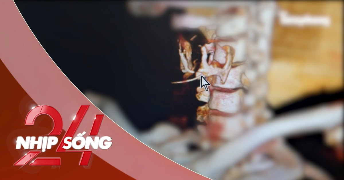 NHỊP SỐNG 24: Cố nuốt cơm chữa hóc xương, người đàn ông 35 tuổi thủng thực quản