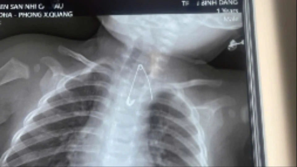 Trẻ bị thủng tá tràng vì nuốt que kẹo mút