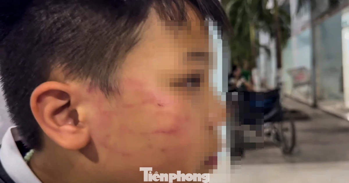 Xác minh bé trai 9 tuổi bị giáo viên người nước ngoài tát vào mặt