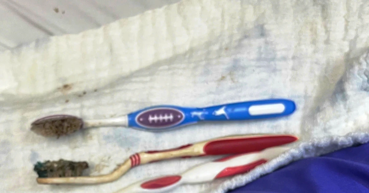 Gắp 3 bàn chải ra khỏi đường tiêu hóa một bệnh nhân tại Huế