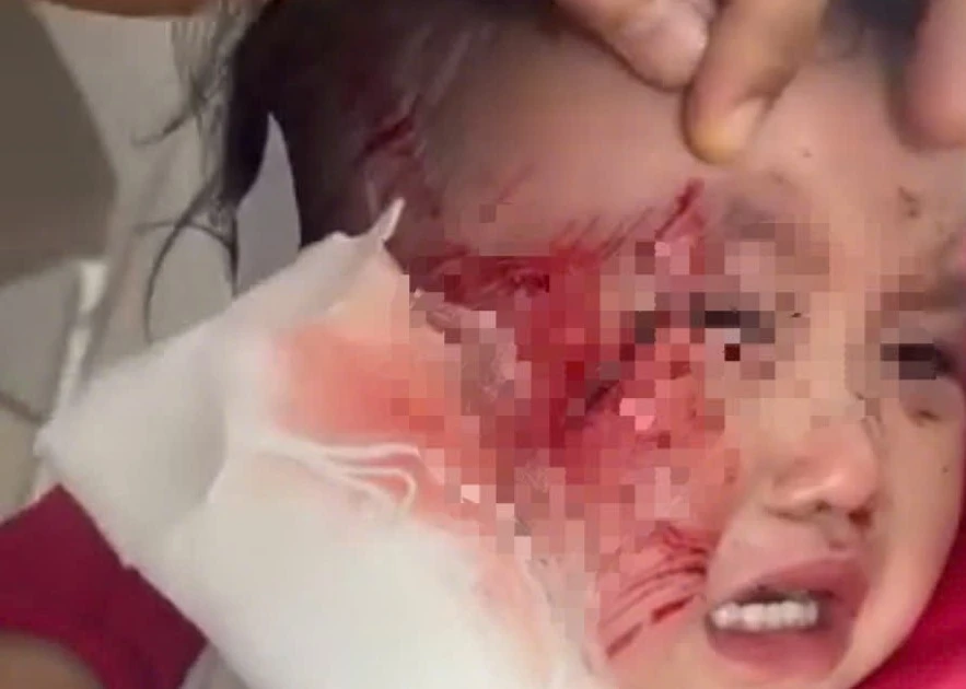 Sập trần thạch cao giờ ngủ trưa, một trẻ mầm non bị thương nặng