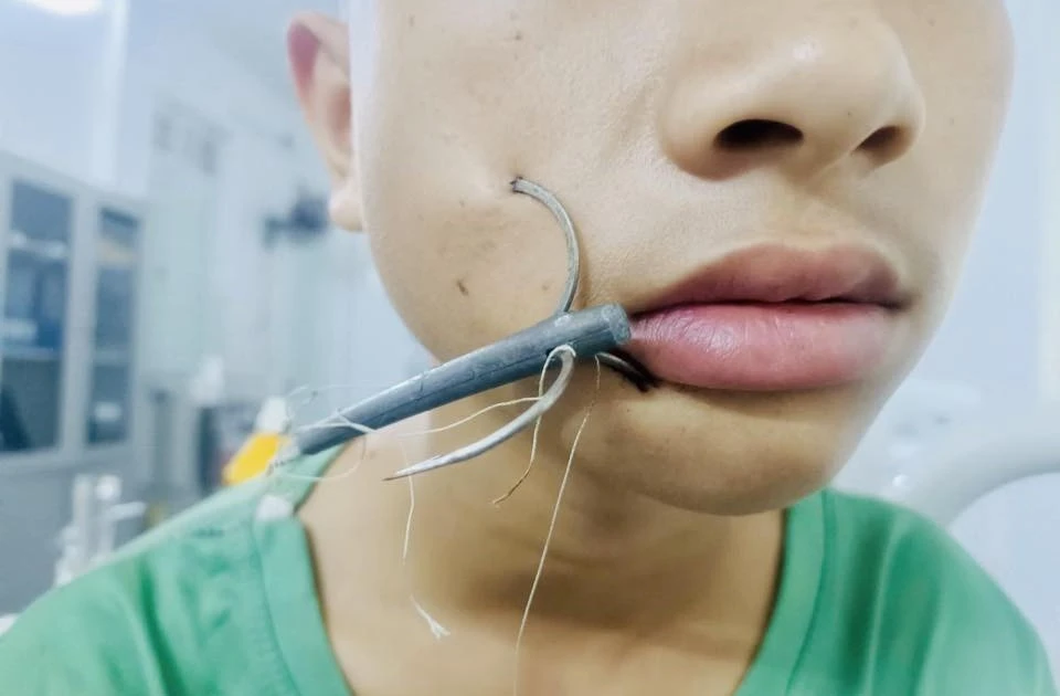 Bé trai 15 tuổi bị lưỡi câu móc sâu vào mặt khi đi câu cá