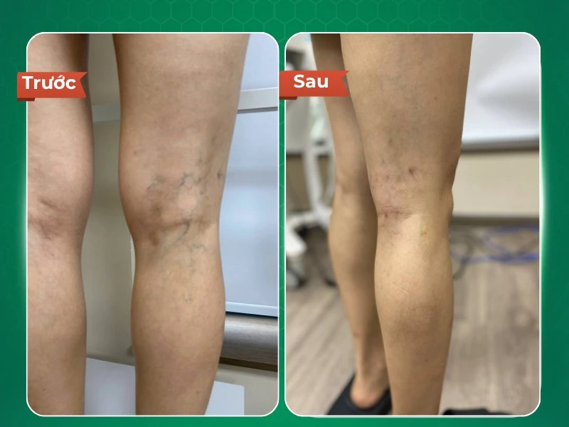 Dr.Vein giải pháp điều trị suy giãn tĩnh mạch bằng gây xơ tĩnh mạch