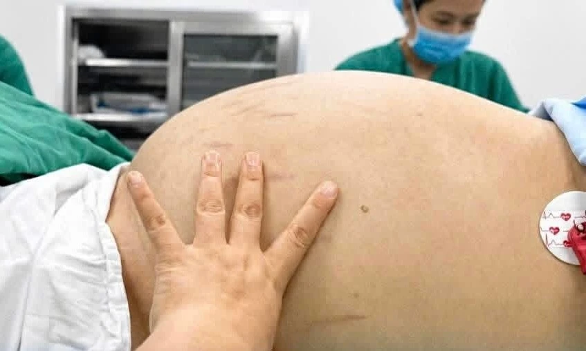 Tưởng bụng lớn do tăng cân, tá hỏa khi biết mình bị u buồng trứng