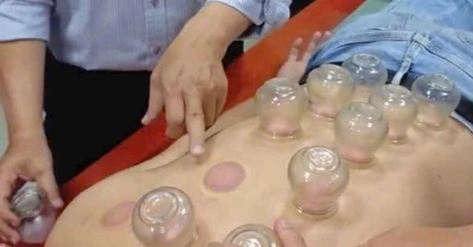 Đột quỵ nặng khi nhờ chị gái giác hơi