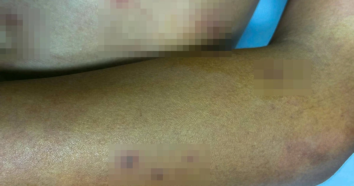 Thiếu niên 14 tuổi ở Cà Mau bị ong vò vẽ đốt 55 vết, nguy kịch