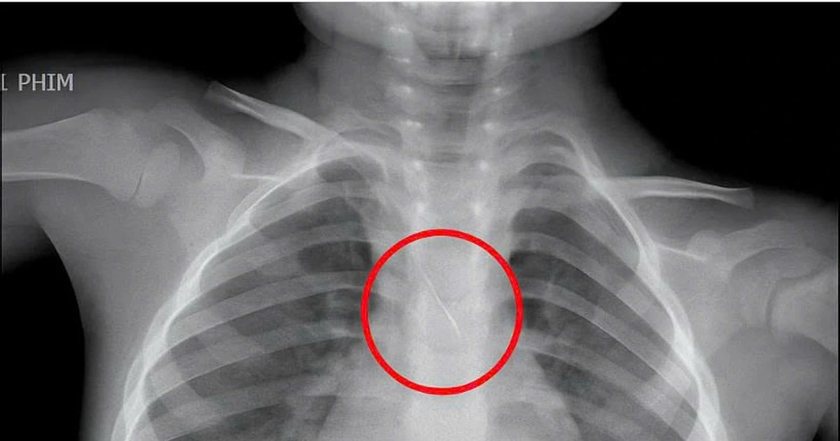 Kim chọc tủy rơi vào đường thở bé trai 3 tuổi khi làm răng