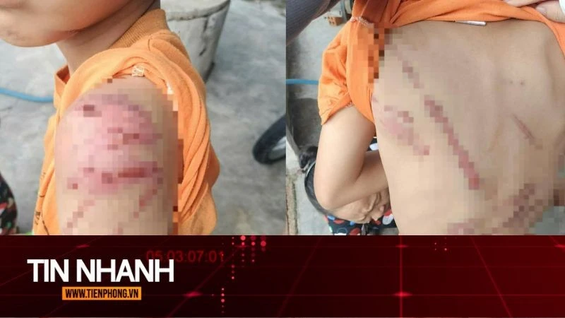 TIN NHANH: Lý do người cha đánh con 10 tuổi bầm tím khắp người