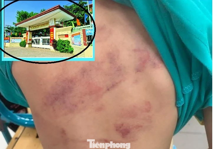 Học sinh lớp 1 bị bạn đánh hội đồng, phụ huynh bức xúc vì con phải chuyển lớp