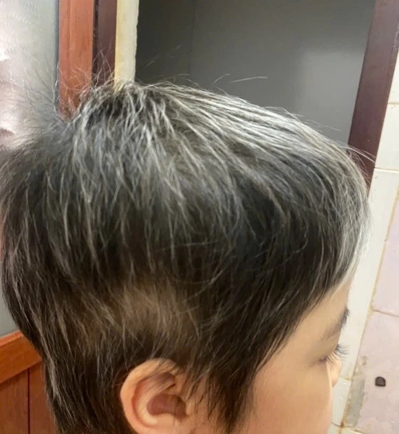 Điều trị thành công cho bệnh nhân 7 tuổi rụng toàn bộ tóc