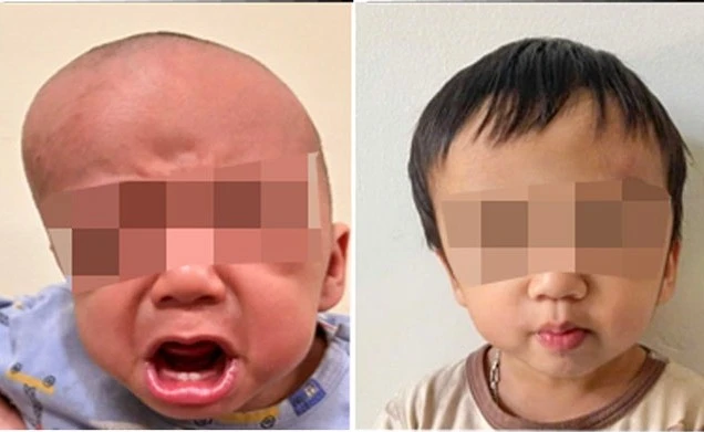 Mỗi ngày kéo giãn hộp sọ 1mm, bác sĩ thay đổi gương mặt trẻ mắc dị tật hiếm gặp
