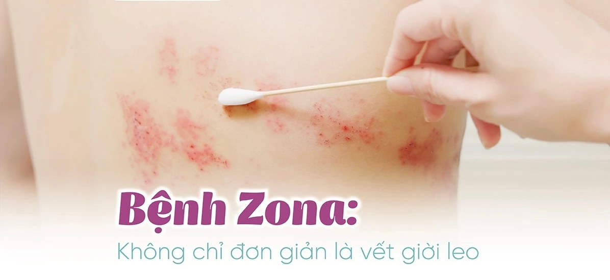 Zona thần kinh: Căn bệnh dễ gặp, biến chứng khó lường