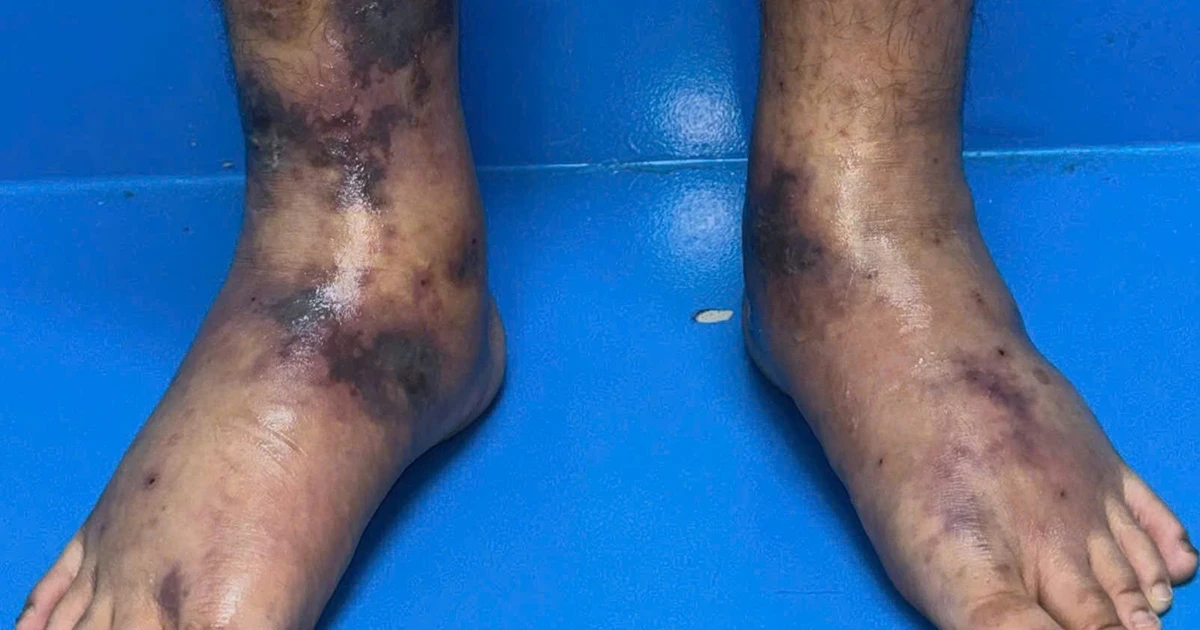 Những nốt ban tím cảnh báo bệnh cực hiếm trên thế giới