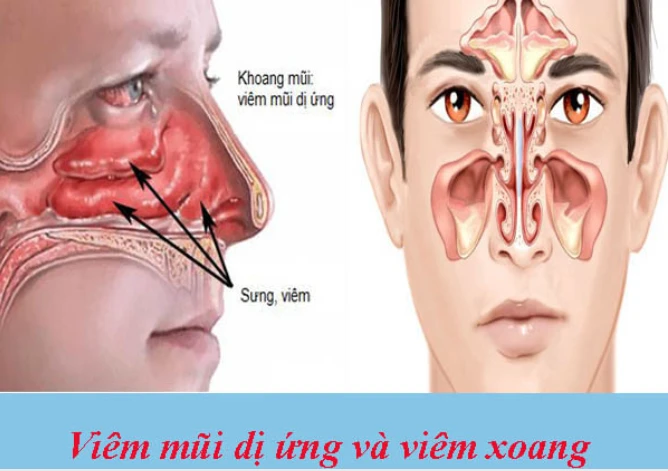 Đừng nhầm viêm mũi dị ứng với viêm xoang: Tự dùng thuốc có thể khiến bệnh nặng hơn