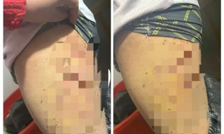 Nữ sinh lớp 7 bị bạn dùng bút bi đâm chi chít vào đùi