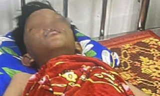 Vật lạ phát nổ, một học sinh lớp 6 bị bỏng nặng