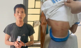 Vụ cha dượng bạo hành con riêng của vợ: Xót xa vết thương trên cơ thể bé gái lớp 5