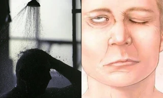 Nam thanh niên 23 tuổi bị liệt dây thần kinh số 7 vì một thói quen khó sửa