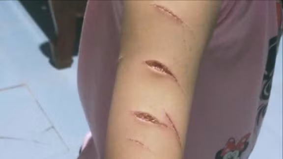 Học sinh lớp 5 ở Cà Mau bị chị họ dùng dao cắt giấy rạch nhiều nhát