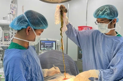 Lấy búi tóc khổng lồ ra khỏi dạ dày bé trai ở Đà Nẵng
