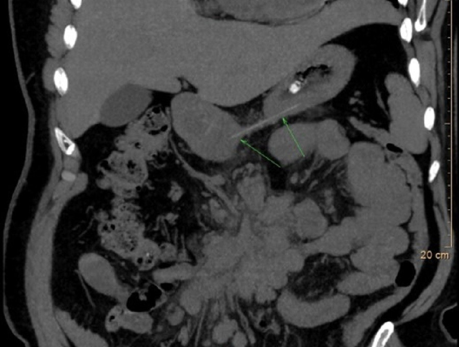 Dị vật xương c&aacute; g&acirc;y tắc đường thở