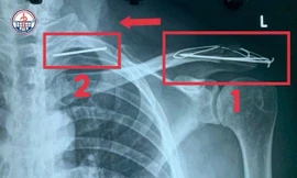 Đinh cố định xương sau phẫu thuật bị gãy, đi 'du lịch' khắp lồng ngực của bệnh nhân 