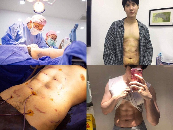 Trai Hàn Quốc, Thái Lan rộ mốt "tạc cơ bụng" để có thân hình 6 múi