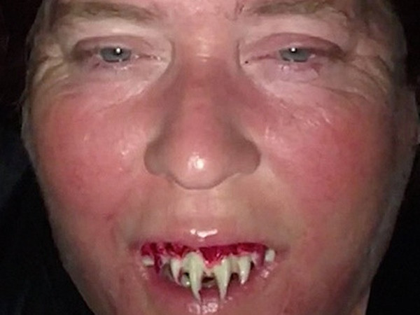 Gắn răng giả hóa trang Halloween, suýt mất răng thật