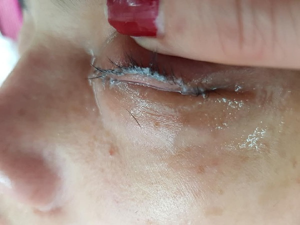 Cô gái bị dính mắt sau khi đi nối lông mi