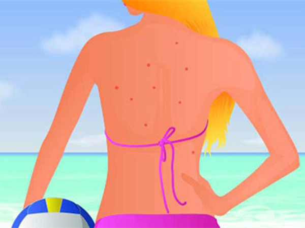 Những thói quen khiến mụn vùng lưng vô tư phát triển