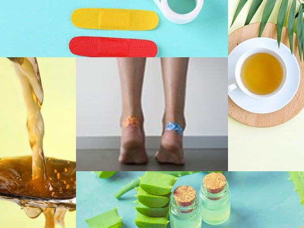 Cách chữa phồng rộp trên da tại nhà hiệu quả