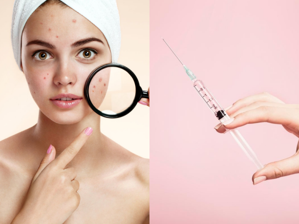 Tin vui cho "hội đèn pin": Khoa học tạo ra thành công vaccine trị mụn vĩnh viễn!