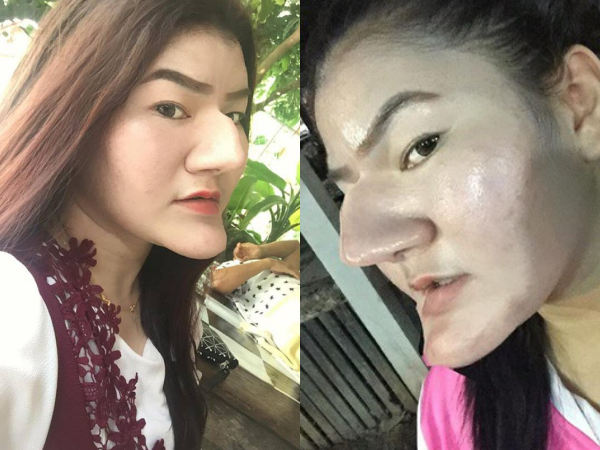 Cô gái với chiếc cằm và mũi biến dạng như phù thủy, lí do khiến ai cũng bất ngờ