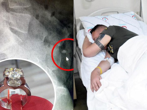 Du khách nuốt vội nhẫn kim cương gần 1 tỷ đồng hòng để phi tang