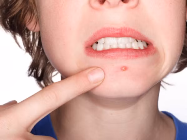 Khoa học chứng minh: Người bị mụn trứng cá thường có điểm số cao và thành công