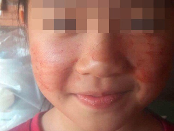 Mắc bệnh lạ, bé 11 tuổi “đổ mồ hôi máu”