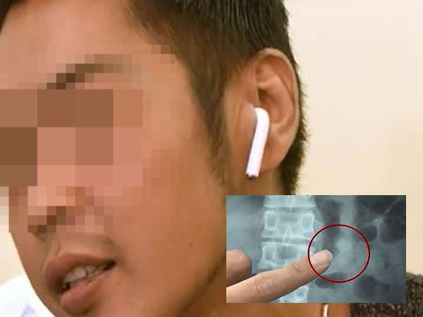 Đi ngủ nuốt nhầm tai phone, sáng dậy chàng trai nghe tiếng nhạc phát ra... từ bụng mình