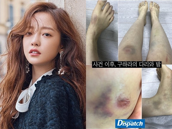 Goo Hara tiết lộ cơ thể đầy thương tích, fan phẫn nộ trước hành vi bạo hành của người bạn trai