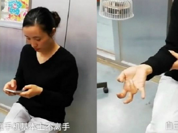 Bàn tay biến dạng vì sử dụng điện thoại không ngừng suốt một tuần