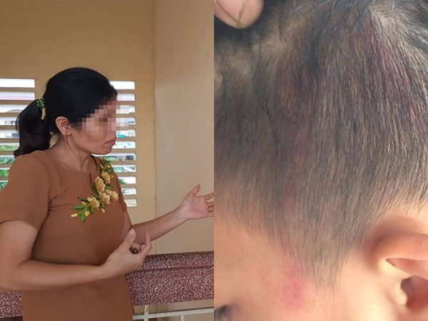 Hải Phòng: Bị "tố" đánh sưng đầu học sinh, Phó hiệu trưởng lên tiếng!