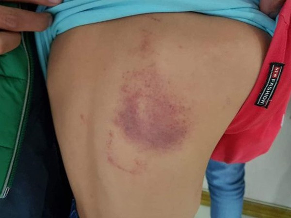 Cô giáo dùng thước vụt học sinh bầm tím vai: Phạt 5 triệu đồng, đình chỉ công tác một tháng