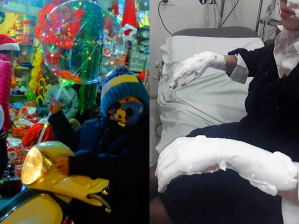 Bóng bay galaxy phát nổ khi gặp tàn thuốc lá, 3 sinh viên bỏng nặng toàn bộ vùng mặt