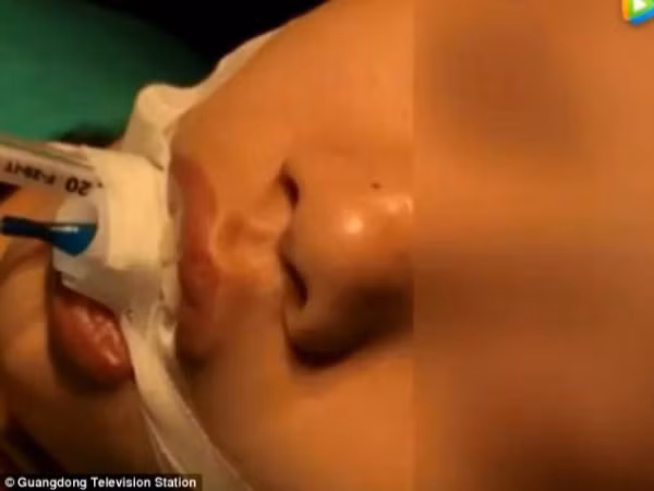 Bé gái 10 tuổi suýt chết vì mẹ nặn mụn đầu đen: Ai còn thói quen này hãy bỏ ngay