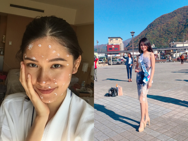 Thùy Dung bị thủy đậu trước chung kết Hoa hậu Quốc tế